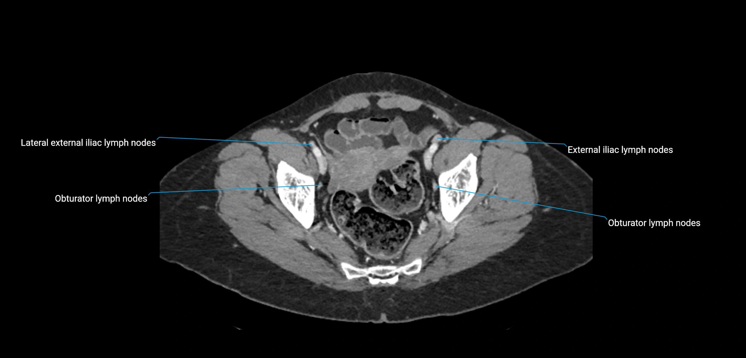CT ct abdominal lymph nodes  axial cross sectional anatomy  enchanced radiology image -img-00002-00363.webp